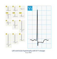 Female, 58 years old, clinically diagnosed with aortic stenosis. Electrocardiogram showed left ventricular hypertrophy and ST-T changes.