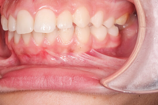 Frontal view of dental maxillary and mandibular arches in occlusion with anterior deep biting teeth, cheeks and lips retracted with cheek retractor. Healthy gingival gum and no decay.