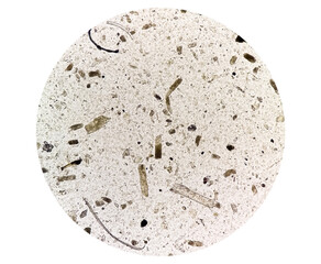Microscopic urine examination showing Granular cast, a sign of many types of kidney diseases.