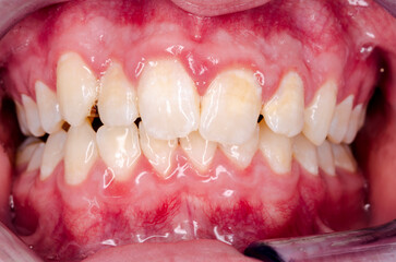 young person with gingivitis