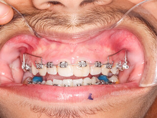 Frontal view of open mouth dental arches with deep overbite biting teeth, bite-raising blue resin...
