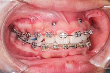 Oblique view of dental arches in biting teeth occlusion, orthodontic braces, elastic O-ring...