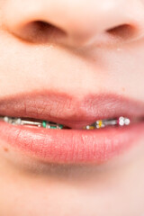 Fototapeta premium Little girl with rainbow braces