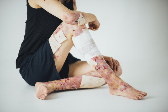 スタジオでモデルをする髪の長い表皮水疱症の女性