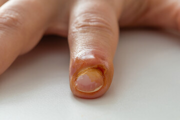Inflammation of the finger. Managing Finger Inflammation.