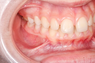 Lateral oblique view of dental maxillary and mandibular arches in occlusion with biting teeth,...