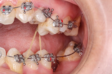 Half mouth open dental arches with orthodontic braces, O-ring ligature and intermaxillary elastic...