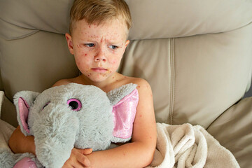 Natural vaccination. Contagious disease. Sick child with chickenpox. Varicella virus or Chickenpox...
