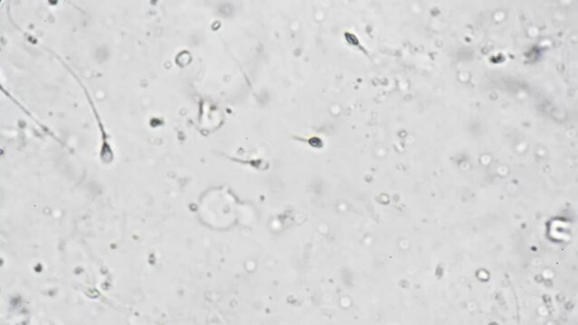 Sperm from the semen of middle-aged man under a microscope magnification 1000 times. A medical fertility reproduction test for a man suffering from the disease. Biological sample of human spermatozoa