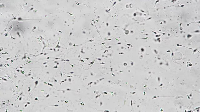 Testing man semen for fertility under microscope magnification of 400 spermatozoa on white background. Person with problems of genitourinary system has passed sperm analysis for tstudy of reproduction