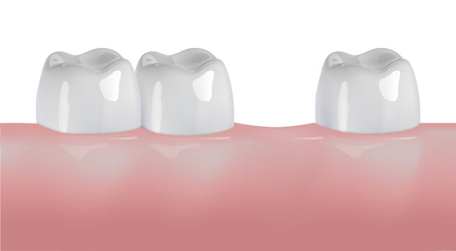 White teeth row in gum. Healthy natural or artificial ceramic implants, crowns or dental bridge. Stomatology or dentist clinic background.