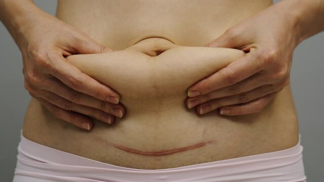 woman grabs and pinches her postpartum belly fat and a c-section scar of caesarean