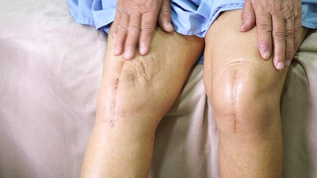 Asian elderly woman patient show her scars surgical total knee joint replacement Suture wound surgery arthroplasty on bed in hospital.