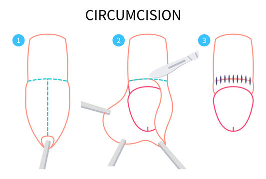 Circumcision paraphimosis for phimosis swelling of medical anatomy pain with HSV and HPV or Herpes simplex virus Redness itchy prepuce Genital candidiasis yeast bacteria preputial adhesion