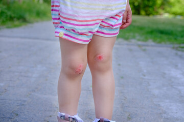 fresh wound, bleeding abrasion on knees of girl child fell on walk, traumatic safety concept for...