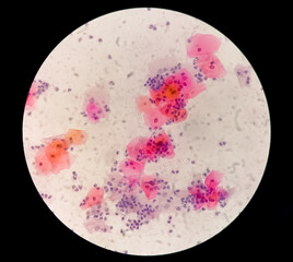 Pap's Smear: Atrophic post menopausal smear containing small pseudo parakeratotic cells (ellipse)...