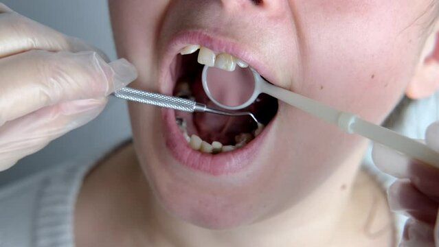 dentist, doctor heals teeth of female patient, uses mouth mirror, closeup oral cavity young woman, concept dentistry, dental treatment, dental prosthetics, oral care, caries prevention
