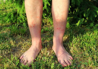Men's legs are badly bitten by mosquitoes and midges living in the grass in summer. Wounds on the skin from the bites of blood-sucking insects.