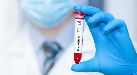 Doctor holding a test blood sample tube positive with hepatitis B virus (HBV) test.Banner. - obrazy, fototapety, plakaty