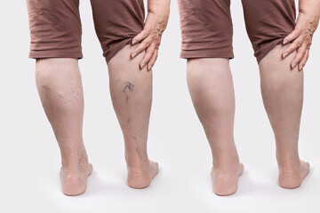 Varicosity. Close up of woman old legs with vascular asterisks. Rear view. Results before and after laser treatment. White background. The concept of varicose veins