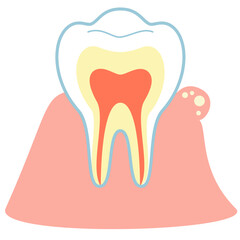 歯茎のできものフィステル