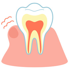 歯肉炎で腫れた歯茎