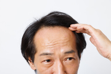 脱毛の問題を抱える成熟した日本人