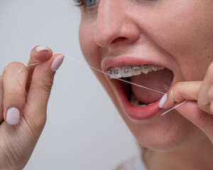 Caucasian woman cleaning her teeth with braces using dental floss. Cropped portrait. 
