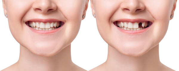 Young woman smiling before and after dental implant.