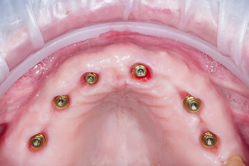 Screwed dental implants in the jaw. Concept of modern procedure in dentistry, dental implants multi unit abutment, real human mouth, upper row. 