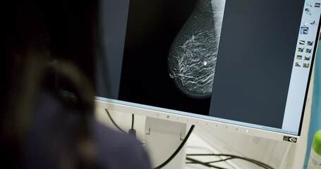 Breast scan on computer monitor. Mammography device in a modern hospital. Handheld shot of mammogram of breast on computer monitor during cancer examination in laboratory of modern clinic.
