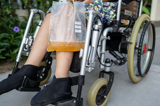 Asian lady disability patient sitting on wheelchair with urine catheter drainage bag in hospital.