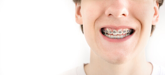  A teenager with dental braces holds interdental brush for cleaning teeth.