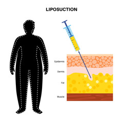 liposuction surgery procedure