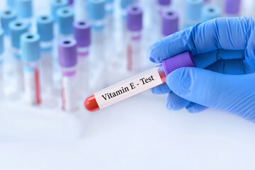 Fototapeta premium Doctor holding a test blood sample tube with Vitamin E test on the background of medical test tubes with analyzes.Banner.Copy space for text