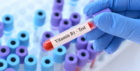 Doctor holding a test blood sample tube with Vitamin B1 test on the background of medical test tubes with analyzes.Banner.Copy space for text