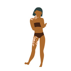 Young woman with vitiligo skin condition isolated on white background.