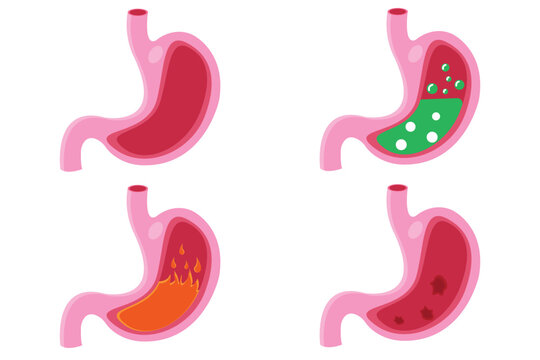 Stomach icon set, cartoon vector illustration. cross section of  normal and abnormal stomach