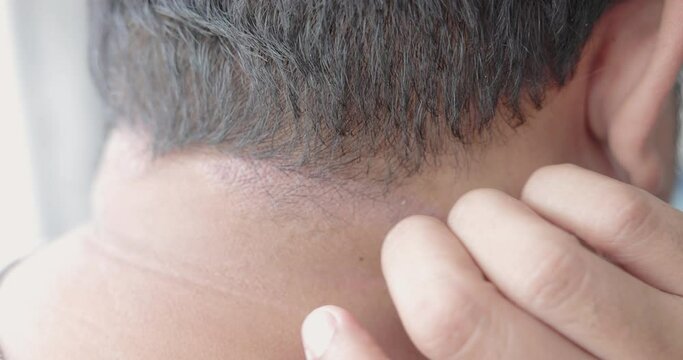 Close-up man scratches sick dry flaky skin and itching. Disease about psoriasis, dermatits, allergies, rash or fungi. Remedis for skin problem concept.