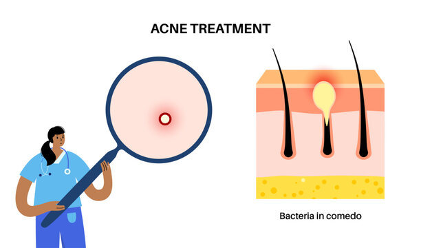 Acne treatment poster
