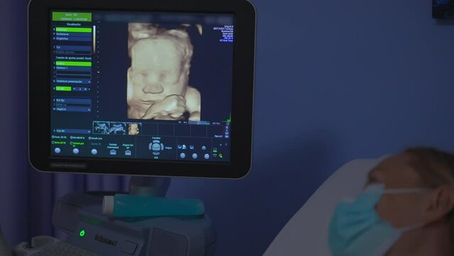 The face of a baby displayed on a screen, obtained through ultrasound screening. This footage offers a precious glimpse into the detailed features of the unborn child, showcasing the marvel of modern