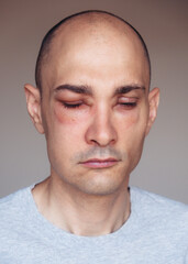 Obraz premium Caucasian man has angioedema around the eyes caused by allergic reaction to agents such as insect bites, foods, or medications. Swollen face.