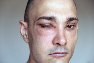 Caucasian man has angioedema around the eyes caused by allergic reaction to agents such as insect...