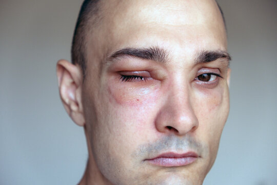 Caucasian man has angioedema around the eyes caused by allergic reaction to agents such as insect bites, foods, or medications. Swollen face, close up.