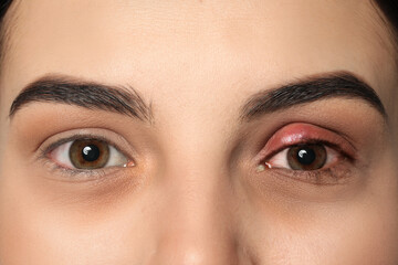 Woman with inflamed eye suffering from conjunctivitis, closeup
