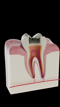 The process of tooth decay
