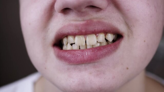 Close up, Wide Smile of a Teenager with Straight, Even Teeth and Plaque. Body part. Portrait. Close-up of lips. Boy with problem skin and pimples shows a toothy smile. Dentistry. Oral hygiene concept.