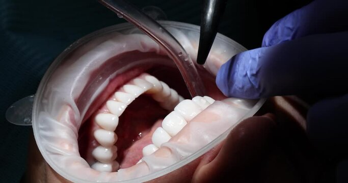 Professional dentist in rubber gloves washes patient oral cavity after installation of ceramic veneers. Treatment of teeth in modern dental clinic