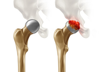 Femoral Head Disease and osteonecrosis or avascular necrosis and aseptic necrosis with a healthy hip compared to an osteoarthritis damaged pelvic joint  - obrazy, fototapety, plakaty