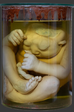 April 1, 2023. Belarus, Minsk.. Gomel. Exhibition of anatomical exhibits. A human infant with the pathological development of anencephaly - the absence of most of the brain, skull and scalp.